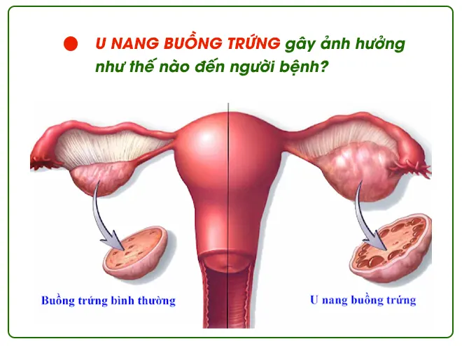 U-nang-buong-trung-gay-anh-huong-khong-nho-den-suc-khoe-sinh-san-cua-nguoi-benh.webp